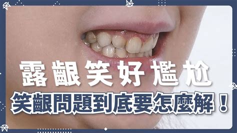 露齦笑在美國滿忌諱的|露齦笑